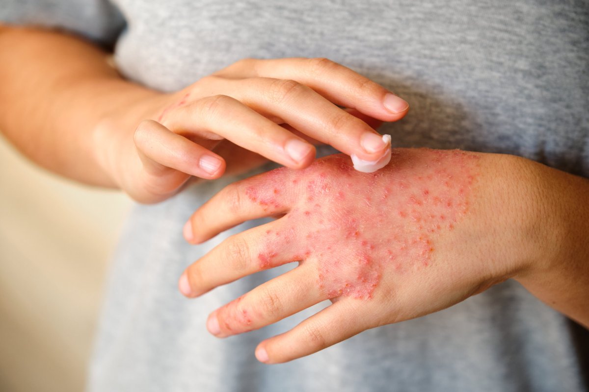 Les allergies, quelles causes ?
